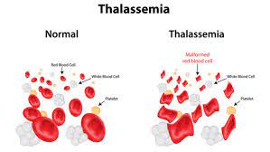 THALASSEMIA (Bệnh tan máu bẩm sinh) – Những kiến thức cần biết